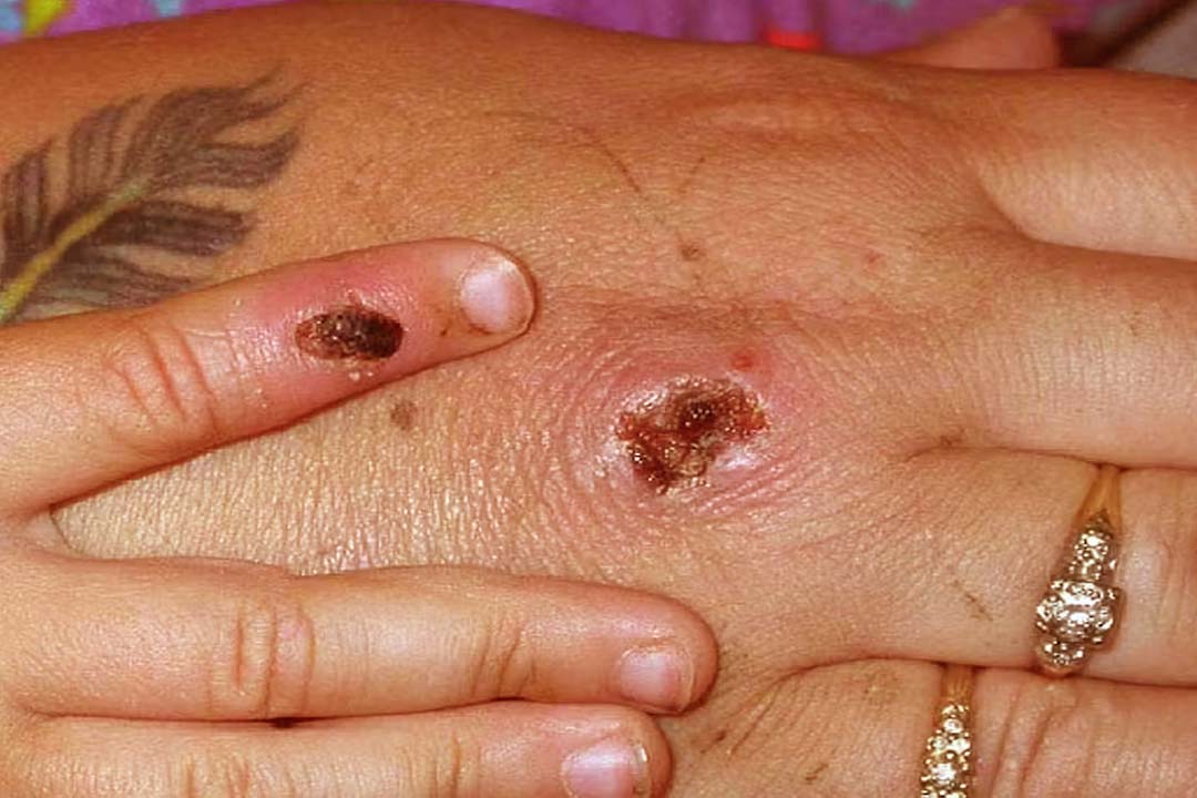 Monkey pox virus found in Punjab