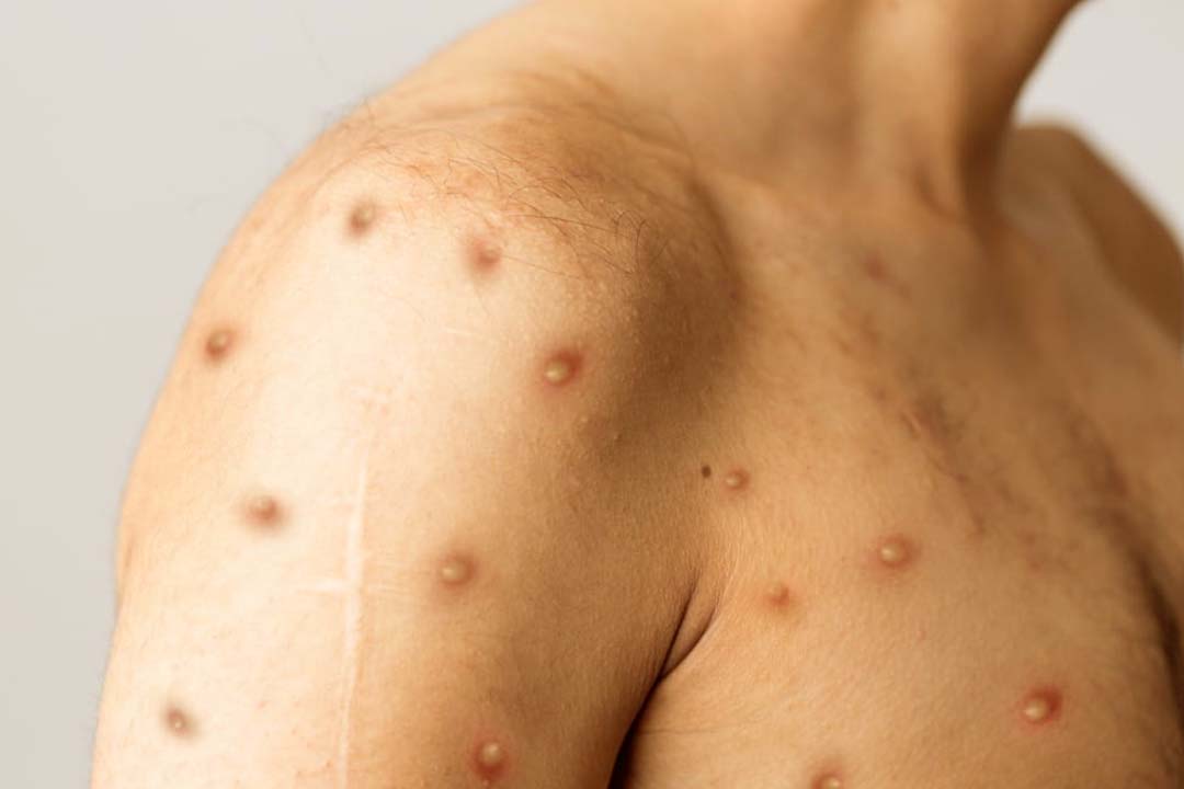 Monkey pox virus found in Punjab